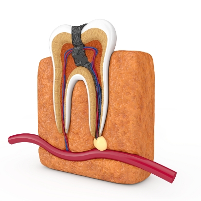 De Schans Dentists Root Canal Treatment